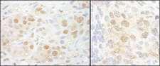 NCBP2 / CBP20 Antibody - Detection of Human and Mouse NCBP2 by Immunohistochemistry. Sample: FFPE section of human breast carcinoma (left) and mouse teratoma (right). Antibody: Affinity purified rabbit anti-NCBP2 used at a dilution of 1:5000 (0.2 ug/ml) and 1:1000 (1 ug/ml). Detection: DAB.