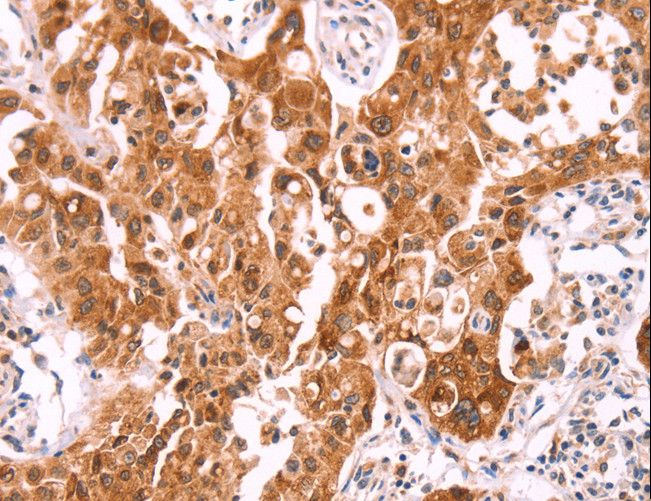 NCEH1 / AADACL1 Antibody - Immunohistochemistry of paraffin-embedded Human lung cancer using NCEH1 Polyclonal Antibody at dilution of 1:80.