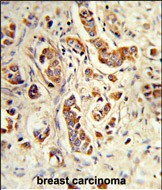 NCF1 / p47phox / p47 phox Antibody - Formalin-fixed and paraffin-embedded human breast carcinoma reacted with NCF1C Antibody (C-term), which was peroxidase-conjugated to the secondary antibody, followed by DAB staining. This data demonstrates the use of this antibody for immunohistochemistry; clinical relevance has not been evaluated.