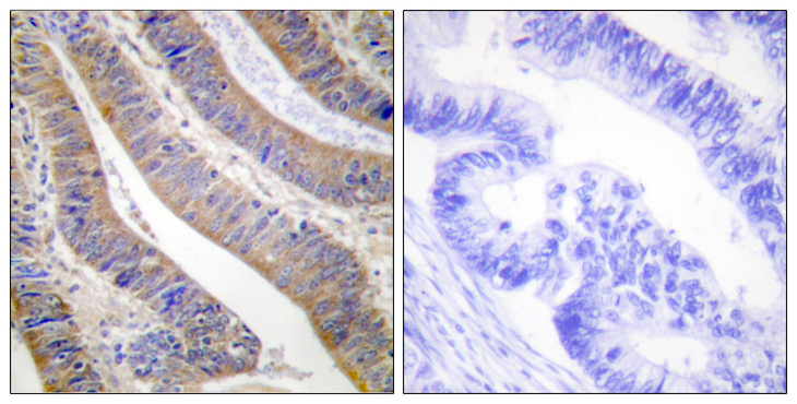 NCF1 / p47phox / p47 phox Antibody - Immunohistochemistry analysis of paraffin-embedded human colon carcinoma tissue, using p47 phox Antibody. The picture on the right is blocked with the synthesized peptide.