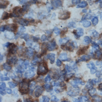 NCF1 / p47phox / p47 phox Antibody - Immunohistochemical analysis of p47 phox staining in human lymphoma formalin fixed paraffin embedded tissue section. The section was pre-treated using heat mediated antigen retrieval with sodium citrate buffer (pH 6.0). The section was then incubated with the antibody at room temperature and detected using an HRP conjugated compact polymer system. DAB was used as the chromogen. The section was then counterstained with hematoxylin and mounted with DPX.