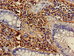 NCF1 / p47phox / p47 phox Antibody - Immunohistochemistry of paraffin-embedded human colon cancer using NCF1 Antibody at dilution of 1:100