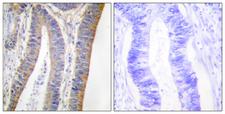 NCF1 / p47phox / p47 phox Antibody - Immunohistochemistry analysis of paraffin-embedded human colon carcinoma, using p47 phox (Phospho-Ser359) Antibody. The picture on the right is blocked with the phospho peptide.