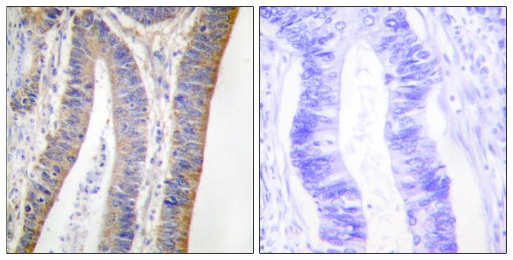 NCF1 / p47phox / p47 phox Antibody - P-peptide - + Immunohistochemistry analysis of paraffin-embedded human colon carcinoma tissue using p47 phox (Phospho-Ser359) antibody.
