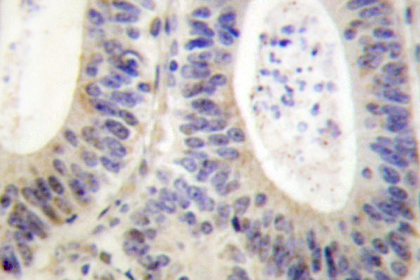 NCF1 / p47phox / p47 phox Antibody - IHC of p47-phox (P300) pAb in paraffin-embedded human colon carcinoma tissue.