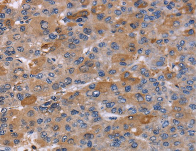NCF2 / NOXA2 / p67phox Antibody - Immunohistochemistry of paraffin-embedded Human liver cancer using NCF2 Polyclonal Antibody at dilution of 1:60.