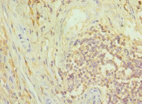 NCK1 / NCK Antibody - Immunohistochemistry of paraffin-embedded human rectal cancer using antibody at 1:100 dilution.