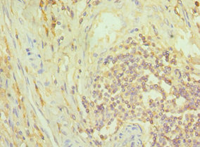 NCK1 / NCK Antibody - Immunohistochemistry of paraffin-embedded human colon cancer using NCK1 Antibody at dilution of 1:100