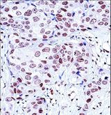 NCK1 / NCK Antibody - NCK1 Antibody immunohistochemistry of formalin-fixed and paraffin-embedded human breast carcinoma followed by peroxidase-conjugated secondary antibody and DAB staining.