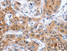 NCK1 / NCK Antibody - Immunohistochemistry of paraffin-embedded Human lung cancer using NCK1 Polyclonal Antibody at dilution of 1:30.