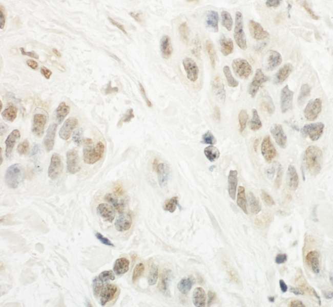 NCKIPSD / AF3P21 Antibody - Detection of Human SPIN90 by Immunohistochemistry. Sample: FFPE section of human breast carcinoma. Antibody: Affinity purified rabbit anti-SPIN90 used at a dilution of 1:1000 (1 ug/ml). Detection: DAB.