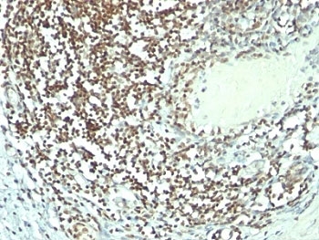 NCL / Nucleolin Antibody - Formalin-fixed, paraffin-embedded human bladder carcinoma stained with Nucleolin antibody (364-5 + NCL/902).  This image was taken for the unmodified form of this product. Other forms have not been tested.