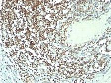 NCL / Nucleolin Antibody - Formalin-fixed, paraffin-embedded human bladder carcinoma stained with Nucleolin antibody (364-5 + NCL/902).  This image was taken for the unmodified form of this product. Other forms have not been tested.
