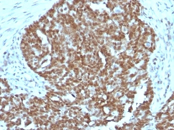 NCL / Nucleolin Antibody - Formalin-fixed, paraffin-embedded human ovarian carcinoma stained with Nucleolin antibody.  This image was taken for the unmodified form of this product. Other forms have not been tested.
