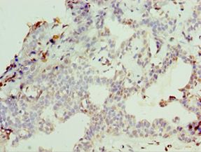 NCL / Nucleolin Antibody - Immunohistochemistry of paraffin-embedded human breast cancer using antibody at 1:100 dilution.