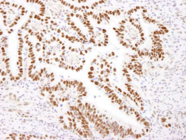 NCL / Nucleolin Antibody - Detection of Human Nucleolin by Immunohistochemistry. Sample: FFPE section of human stomach carcinoma. Antibody: Affinity purified rabbit anti-Nucleolin used at a dilution of 1:200 (1 ug/ml). Detection: DAB.
