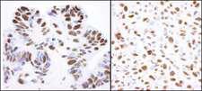 NCL / Nucleolin Antibody - Detection of Human and Mouse Nucleolin by Immunohistochemistry. Sample: FFPE section of human ovarian carcinoma (left) and mouse squamous cell carcinoma (right). Antibody: Affinity purified rabbit anti-Nucleolin used at a dilution of 1:1000 (0.2 ug/ml). Detection: DAB.