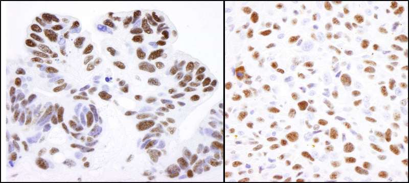 NCL / Nucleolin Antibody - Detection of Human and Mouse Nucleolin by Immunohistochemistry. Sample: FFPE section of human ovarian carcinoma (left) and mouse squamous cell carcinoma (right). Antibody: Affinity purified rabbit anti-Nucleolin used at a dilution of 1:1000 (0.2 ug/ml). Detection: DAB.