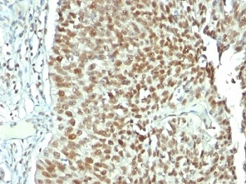 NCL / Nucleolin Antibody - Formalin-fixed, paraffin-embedded human bladder carcinoma stained with Nucleolin antibody.  This image was taken for the unmodified form of this product. Other forms have not been tested.