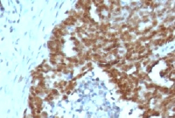 NCL / Nucleolin Antibody - Formalin-fixed, paraffin-embedded human ovarian carcinoma stained with Nucleolin antibody.  This image was taken for the unmodified form of this product. Other forms have not been tested.