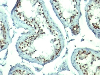 NCL / Nucleolin Antibody - Formalin-fixed, paraffin-embedded human testicular carcinoma stained with Nucleolin antibody.  This image was taken for the unmodified form of this product. Other forms have not been tested.