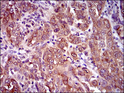 NCLN Antibody - IHC of paraffin-embedded endometrial cancer tissues using CLGN mouse monoclonal antibody with DAB staining.