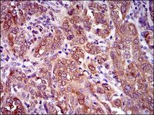 NCLN Antibody - IHC of paraffin-embedded endometrial cancer tissues using CLGN mouse monoclonal antibody with DAB staining.