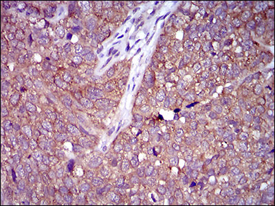 NCLN Antibody - IHC of paraffin-embedded bladder cancer tissues using CLGN mouse monoclonal antibody with DAB staining.