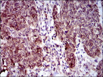NCLN Antibody - IHC of paraffin-embedded breast cancer tissues using CLGN mouse monoclonal antibody with DAB staining.