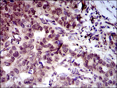 NCLN Antibody - IHC of paraffin-embedded esophageal cancer tissues using CLGN mouse monoclonal antibody with DAB staining.