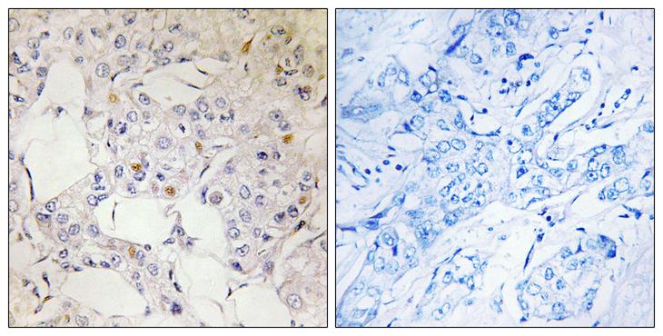 NCOA2 / TIF2 Antibody - Peptide - + Immunohistochemistry analysis of paraffin-embedded human breast carcinoma tissue using NCoA2 antibody.