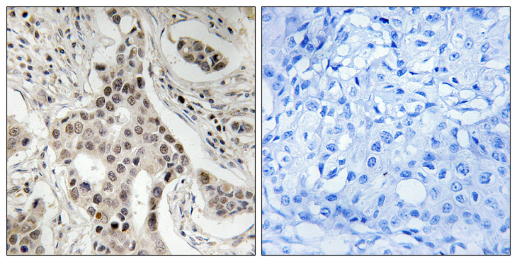 NCOA2 / TIF2 Antibody - Immunohistochemistry analysis of paraffin-embedded human breast carcinoma, using NCoA2 (Phospho-Ser736) Antibody. The picture on the right is blocked with the phospho peptide.
