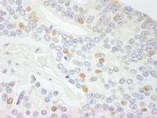 NCOA5 Antibody - Detection of Human NCOA5 (CIA) by Immunohistochemistry. Sample: FFPE section of human prostate carcinoma. Antibody: Affinity purified rabbit anti-NCOA5 (CIA) used at a dilution of 1:200 (1 ug/ml). Detection: DAB.
