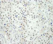 NCOA5 Antibody - Detection of Human NCOA5/CIA by Immunohistochemistry. Sample: FFPE section of human breast carcinoma. Antibody: Affinity purified rabbit anti-NCOA5/CIA used at a dilution of 1:250. Epitope Retrieval Buffer-High pH (IHC-101J) was substituted for Epitope Retrieval Buffer-Reduced pH.