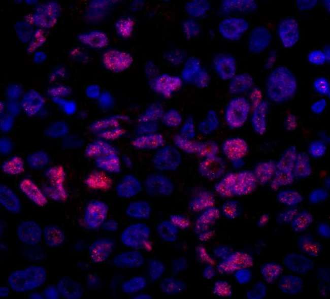 NCOA5 Antibody - Detection of Human NCOA5/CIA by Immunohistochemistry. Sample: FFPE section of human ovarian carcinoma. Antibody: Affinity purified rabbit anti-NCOA5/CIA used at a dilution of 1:100. Detection: Red-fluorescent goat anti-rabbit IgG highly cross-adsorbed Antibody used at a dilution of 1:100. Epitope Retrieval Buffer-High pH (IHC-101J) was substituted for Epitope Retrieval Buffer-Reduced pH.