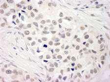 NCOA5 Antibody - Detection of Human NCOA5 (CIA) by Immunohistochemistry. Sample: FFPE section of human breast carcinoma. Antibody: Affinity purified rabbit anti-NCOA5 (CIA) used at a dilution of 1:200 (1 ug/ml). Detection: DAB.