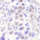 NCOA6 / ASC-2 Antibody - Detection of Human ASC2 by Immunohistochemistry. Sample: FFPE section of human breast carcinoma. Antibody: Affinity purified rabbit anti-ASC2 used at a dilution of 1:1000 (1 ug/ml).