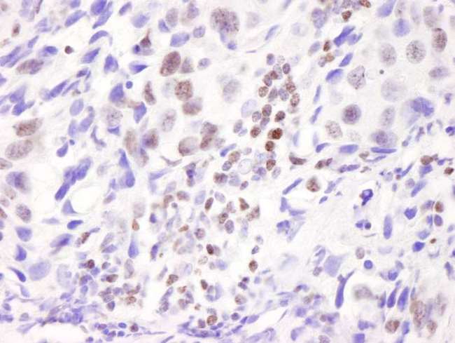 NCOA6 / ASC-2 Antibody - Detection of Human ASC2 by Immunohistochemistry. Sample: FFPE section of human breast adenocarcinoma. Antibody: Affinity purified rabbit anti-ASC2 used at a dilution of 1:100. Detection: DAB.