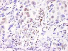 NCOA6 / ASC-2 Antibody - Detection of Human ASC2 by Immunohistochemistry. Sample: FFPE section of human breast adenocarcinoma. Antibody: Affinity purified rabbit anti-ASC2 used at a dilution of 1:100. Detection: DAB.