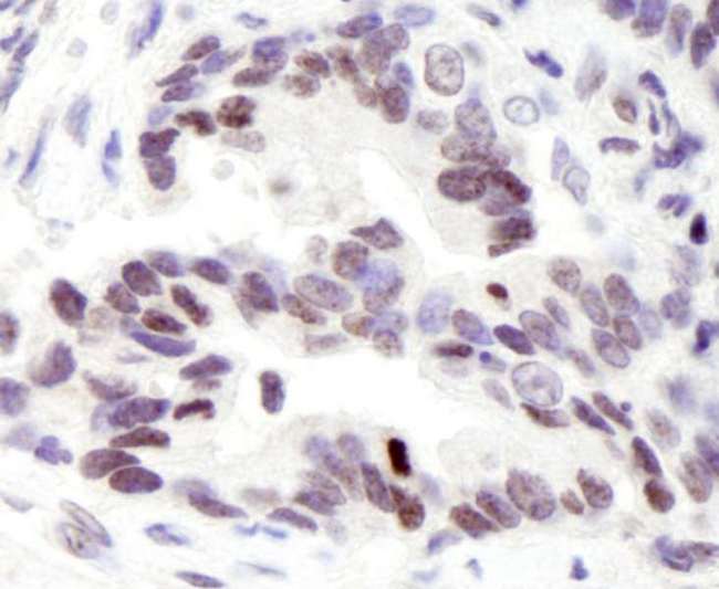 NCOA6 / ASC-2 Antibody - Detection of Human ASC2 by Immunohistochemistry. Sample: FFPE section of human stomach adenocarcinoma. Antibody: Affinity purified rabbit anti-ASC2 used at a dilution of 1:100. Detection: DAB.