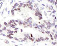 NCOA6 / ASC-2 Antibody - Detection of Human ASC2 by Immunohistochemistry. Sample: FFPE section of human stomach carcinoma. Antibody: Affinity purified rabbit anti-ASC2 used at a dilution of 1:1000 (1 ug/ml).