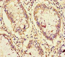NCOA6 / ASC-2 Antibody - Immunohistochemistry of paraffin-embedded human colon cancer at dilution of 1:100