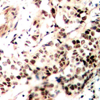 NCOR2 / SMRT Antibody - Immunohistochemical analysis of SMRT staining in human breast cancer formalin fixed paraffin embedded tissue section. The section was pre-treated using heat mediated antigen retrieval with sodium citrate buffer (pH 6.0). The section was then incubated with the antibody at room temperature and detected using an HRP conjugated compact polymer system. DAB was used as the chromogen. The section was then counterstained with hematoxylin and mounted with DPX.