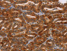 NCR1 / NKP46 Antibody - Immunohistochemistry of paraffin-embedded Human liver cancer using NCR1 Polyclonal Antibody at dilution of 1:30.