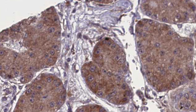 NCR1 / NKP46 Antibody - 1:100 staining human liver carcinoma tissues by IHC-P. The sample was formaldehyde fixed and a heat mediated antigen retrieval step in citrate buffer was performed. The sample was then blocked and incubated with the antibody for 1.5 hours at 22°C. An HRP conjugated goat anti-rabbit antibody was used as the secondary.