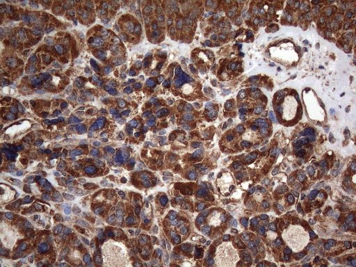 NCR2 / NKP44 Antibody - Immunohistochemical staining of paraffin-embedded Carcinoma of Human thyroid tissue using anti-NCR2 mouse monoclonal antibody. (Heat-induced epitope retrieval by 1mM EDTA in 10mM Tris buffer. (pH8.5) at 120°C for 3 min. (1:150)