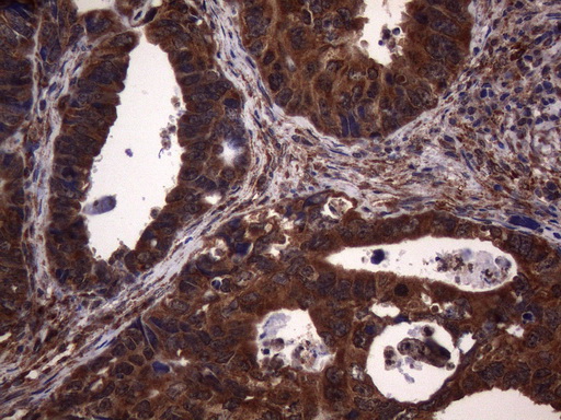 NCR2 / NKP44 Antibody - Immunohistochemical staining of paraffin-embedded Adenocarcinoma of Human colon tissue using anti-NCR2 mouse monoclonal antibody. (Heat-induced epitope retrieval by 1mM EDTA in 10mM Tris buffer. (pH8.5) at 120°C for 3 min. (1:150)