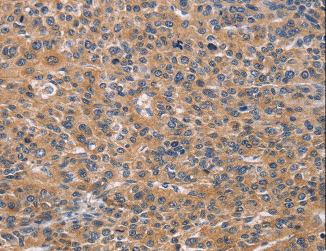 NCR2 / NKP44 Antibody - Immunohistochemistry of paraffin-embedded Human lung cancer using NCR2 Polyclonal Antibody at dilution of 1:60.