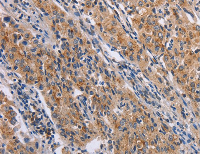 NCR2 / NKP44 Antibody - Immunohistochemistry of paraffin-embedded Human lung cancer using NCR2 Polyclonal Antibody at dilution of 1:60.