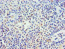 NCS1 / Neuronal Calcium Sensor Antibody - Immunohistochemistry of paraffin-embedded human breast cancer using antibody at 1:100 dilution.